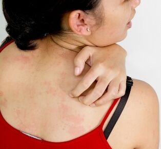 Granuloma on the body - symptoms of the presence of parasites