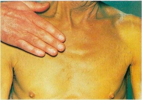 Jaundice due to parasites in the body